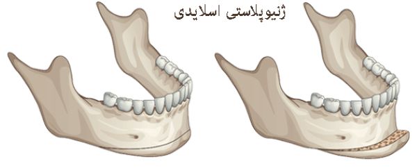 جراحی جینوپلاستی چانه چیست و چه افرادی به آن نیاز دارند جراحی چانه عمل زیبایی جراحی چانه