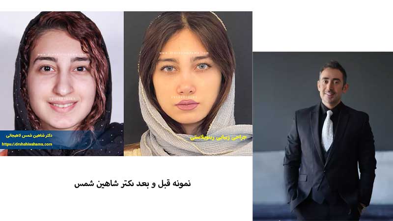 بهترین دکتر عمل بینی در تهران | جراح رینوپلاستی خوب تهران بهترین دکتر بینی تهران نمونه قبل و بعد جراحی بینی دکتر شاهین شمس