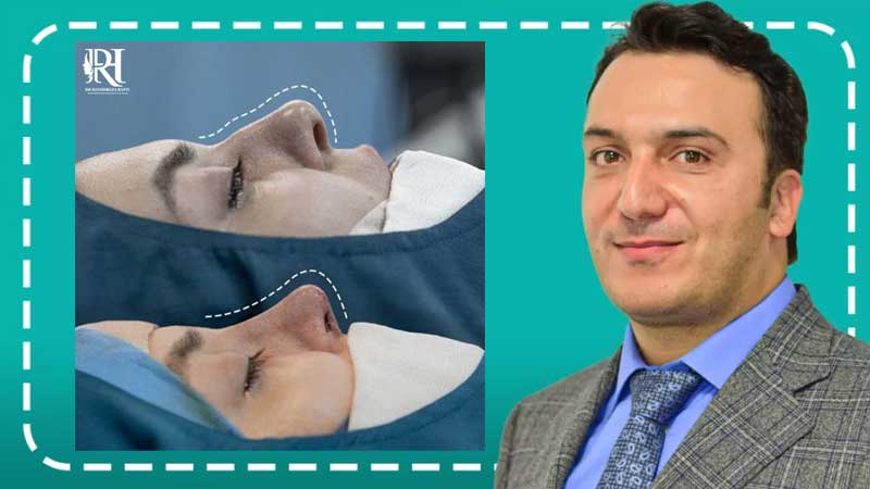 بهترین دکتر عمل بینی در تهران | جراح رینوپلاستی خوب تهران بهترین دکتر بینی تهران نمونه قبل و بعد عمل بینی دکتر حمیدرضا راستی