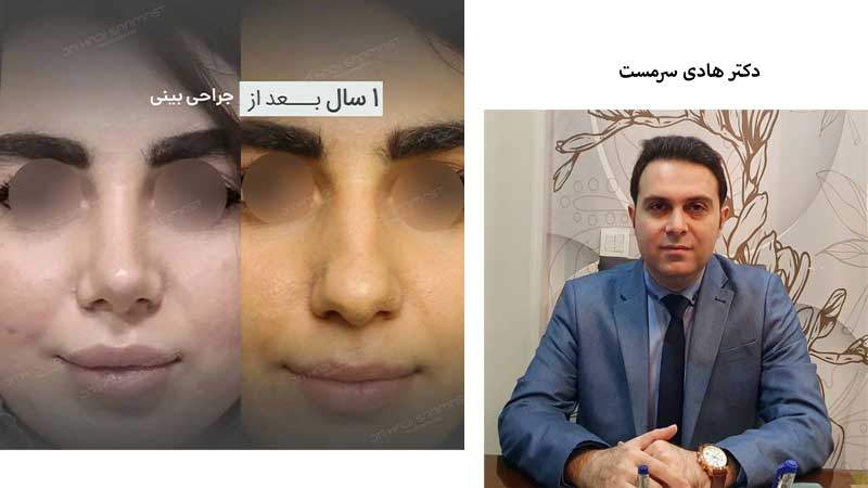 بهترین دکتر عمل بینی در تهران | جراح رینوپلاستی خوب تهران بهترین دکتر بینی تهران نمونه قبل و بعد عمل بینی دکتر هادی سرمست