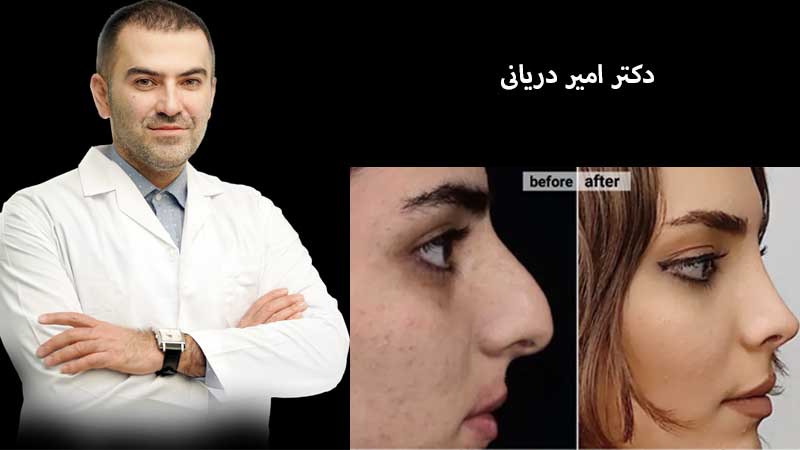 بهترین دکتر عمل بینی در تهران | جراح رینوپلاستی خوب تهران بهترین دکتر بینی تهران نمونه قبل و بعد جراحی زیبایی دکتر امیر دریانی