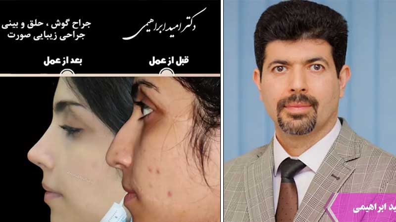 بهترین دکتر عمل بینی در تهران | جراح رینوپلاستی خوب تهران بهترین دکتر بینی تهران نمونه قبل و بعد عمل بینی دکتر امید ابراهیمی
