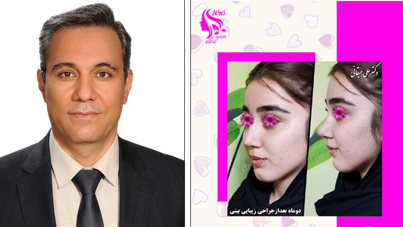 بهترین دکتر عمل بینی در تهران | جراح رینوپلاستی خوب تهران بهترین دکتر بینی تهران نمونه قبل و بعد جراحی بینی دکتر علی میقانی