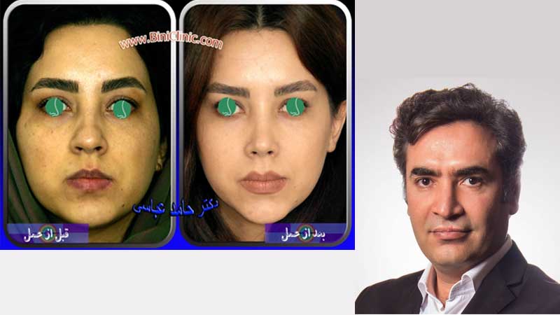بهترین دکتر عمل بینی در تهران | جراح رینوپلاستی خوب تهران بهترین دکتر بینی تهران نمونه قبل و بعد عمل بینی دکتر حامد عباسی
