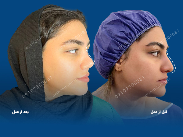 عمل انحراف بینی چگونه انجام می شود عمل انحراف بینی انحراف بینی