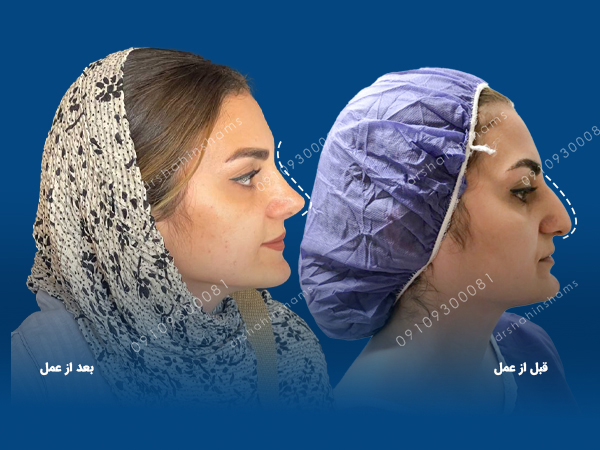 عمل انحراف بینی چگونه انجام می شود عمل انحراف بینی عکس قبل و بعد عمل انحراف بینی