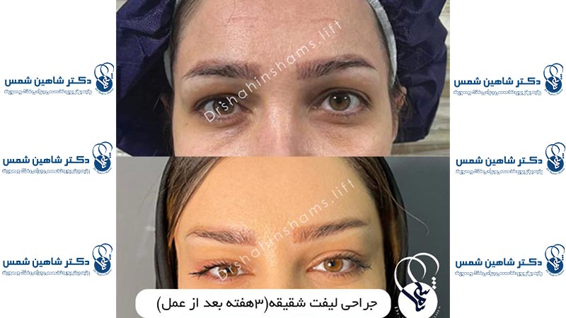 عمل لیفت شقیقه با جراحی بهمراه عکس لیفت شقیقه لیفت شقیقه با جراحی عکس نمونه کار قبل و بعد لیفت شقیقه 3 هفته بعد از عمل