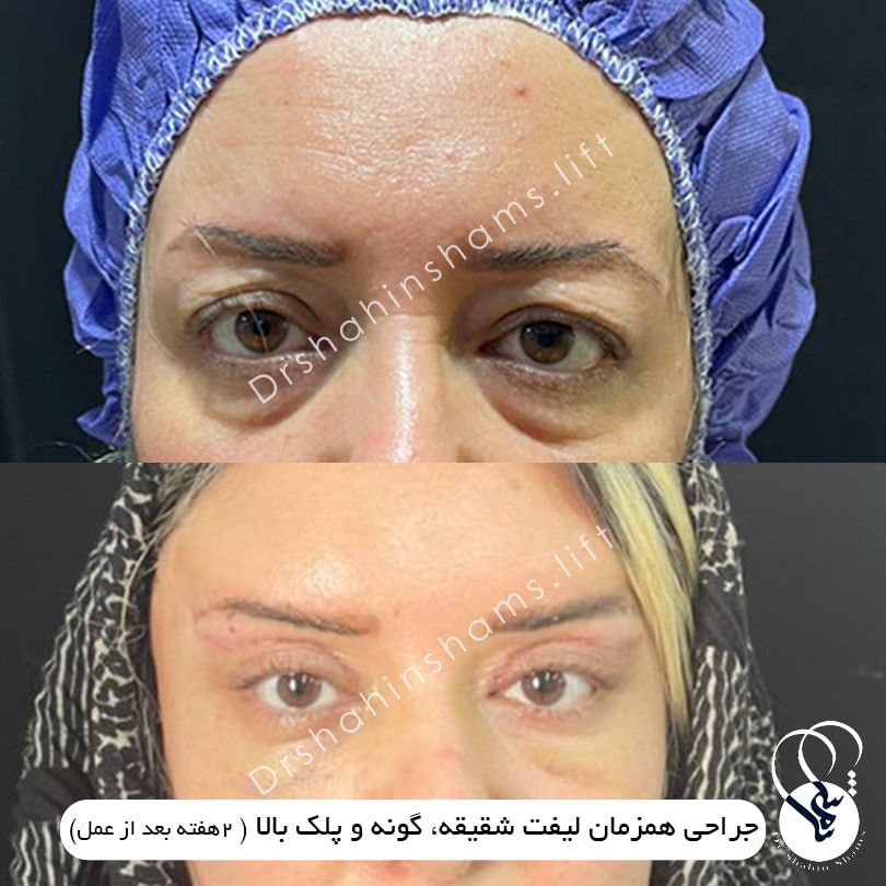 نمونه قبل و بعد عمل همزمان لیفت شقیقه و گونه و پلک 01 نمونه قبل و بعد جراحی زیبایی همزمان لیفت شقیقه و گونه و پلک