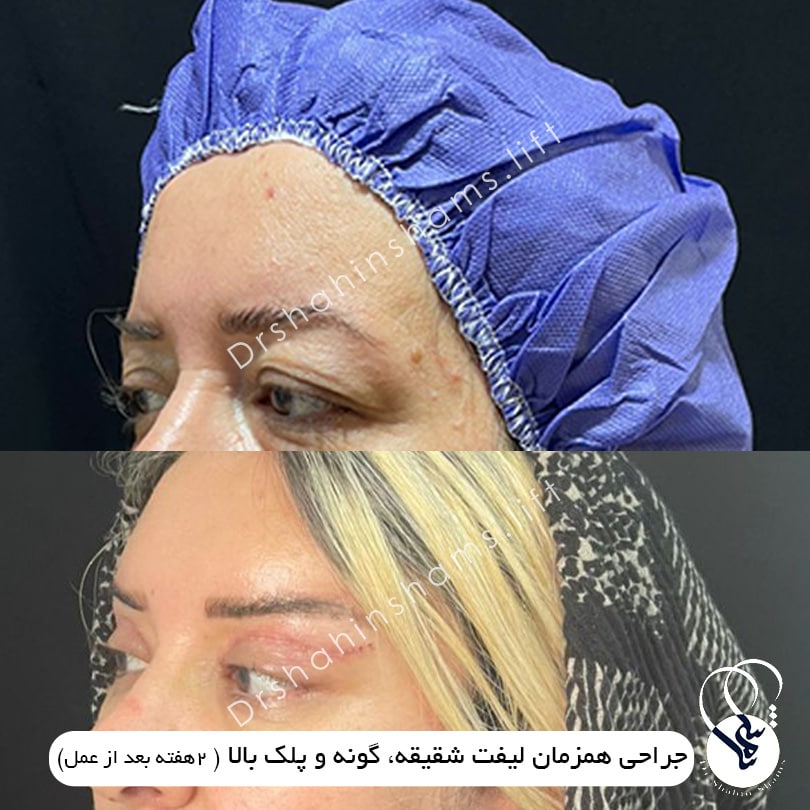 نمونه قبل و بعد عمل همزمان لیفت شقیقه و گونه و پلک 01 نمونه قبل و بعد جراحی زیبایی همزمان لیفت شقیقه و گونه و پلک