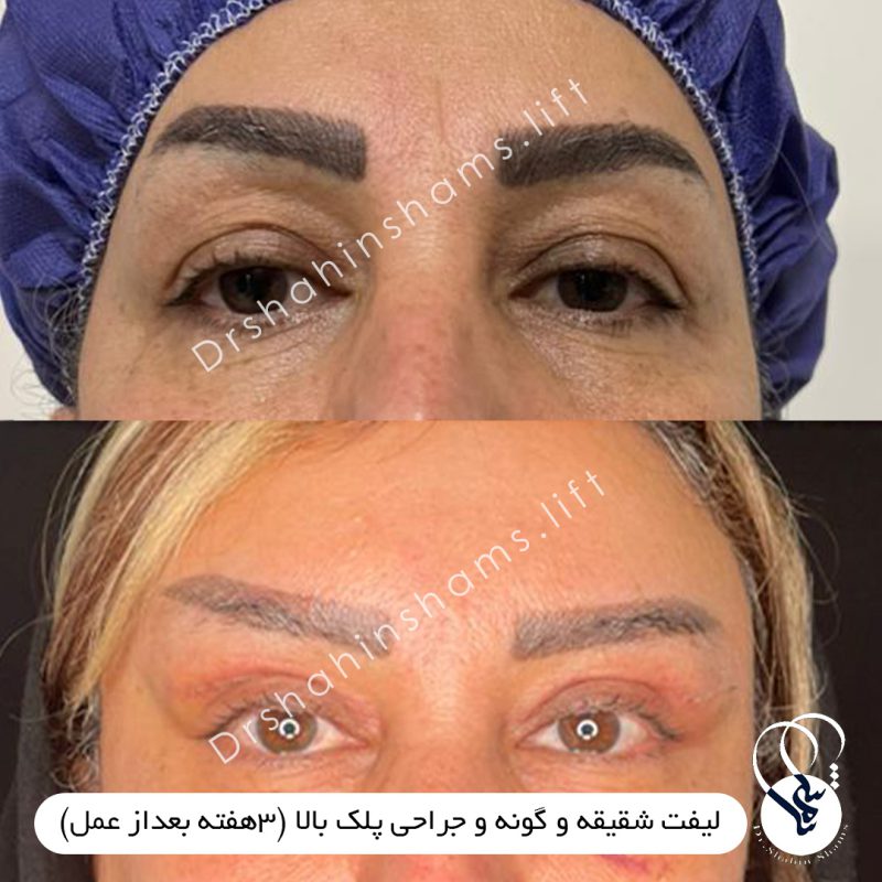 نمونه قبل و بعد لیفت شقیقه و گونه همزمان 01LC004 نمونه قبل و بعد لیفت شقیقه و گونه همزمان ليفت شقیقه و گونه