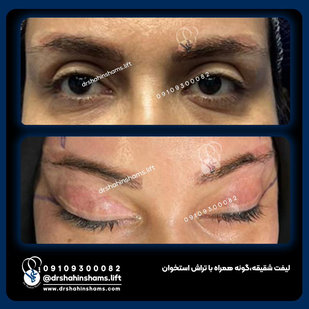 نمونه قبل و بعد لیفت همزمان شقیقه و گونه و تراش استخوان کد 01l037 جراحی لیفت شقیقه همرا با فیلم قبل و بعد