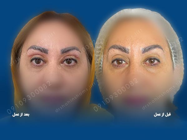 مراقبت بعد از جراحی پلک بالا یا پایین مراقبت بعد از جراحی پلک مراقبت بعد از جراحی پلک بالا یا پایینمراقبت بعد از جراحی پلک بالا یا پایین
