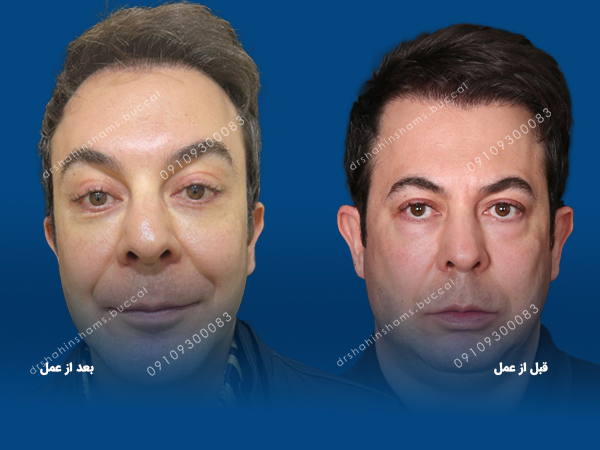 مراقبت بعد از جراحی پلک بالا یا پایین مراقبت بعد از جراحی پلک جراحی فک برای اقایان