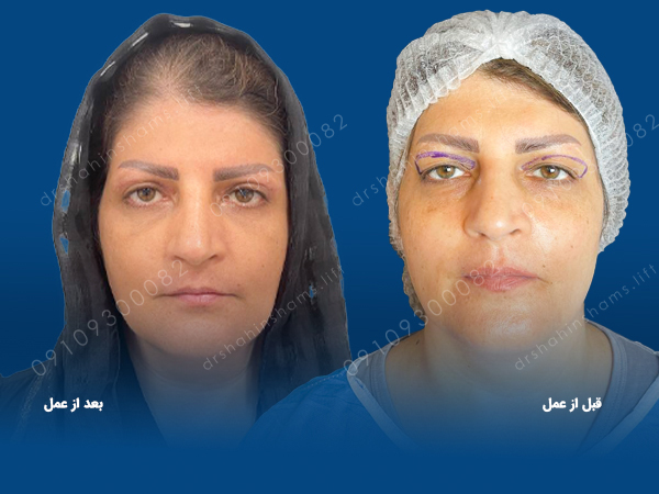 مراقبت بعد از جراحی پلک بالا یا پایین مراقبت بعد از جراحی پلک دوران نقاهت بلفاروپلاستی