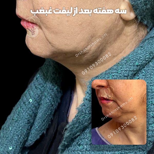 نمونه قبل و بعد لیپوساکشن غبغب کد 01LC021 نمونه قبل و بعد لیپوساکشن غبغب نمونه قبل و بعد لیپوساکشن غبغب