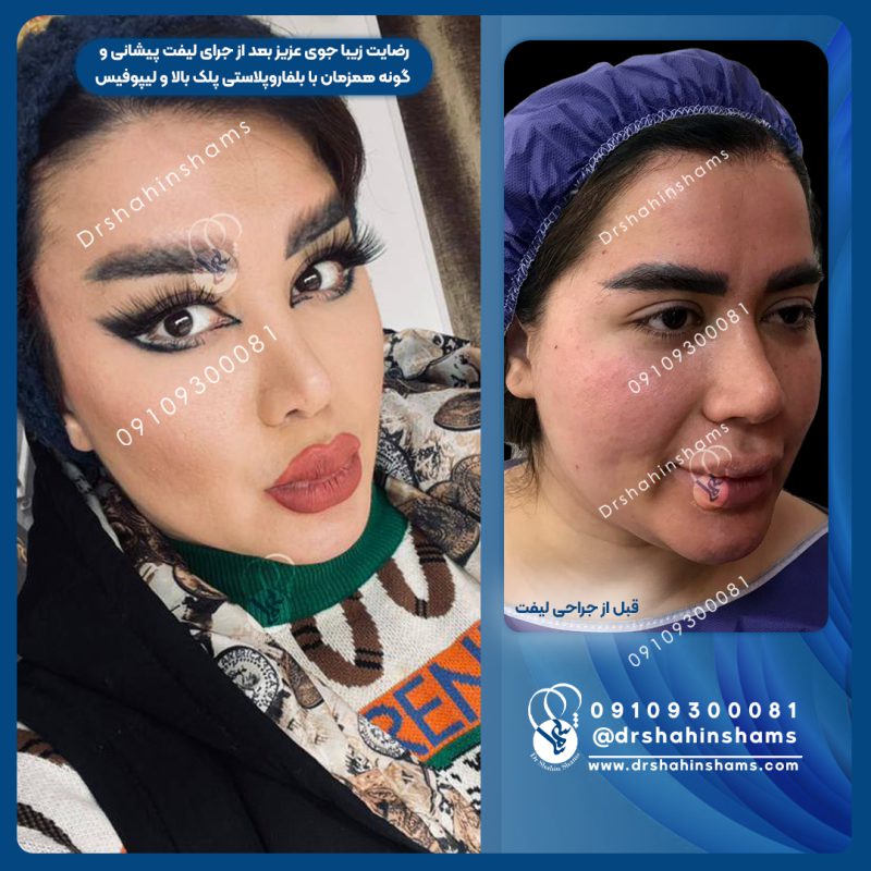 عمل لیفت صورت و پلک و بوکال و غبغب نمونه 01LC024 نمونه قبل و بعد لیفت همزمان پیشانی و گونه و پلک بالا و لیپوفیس