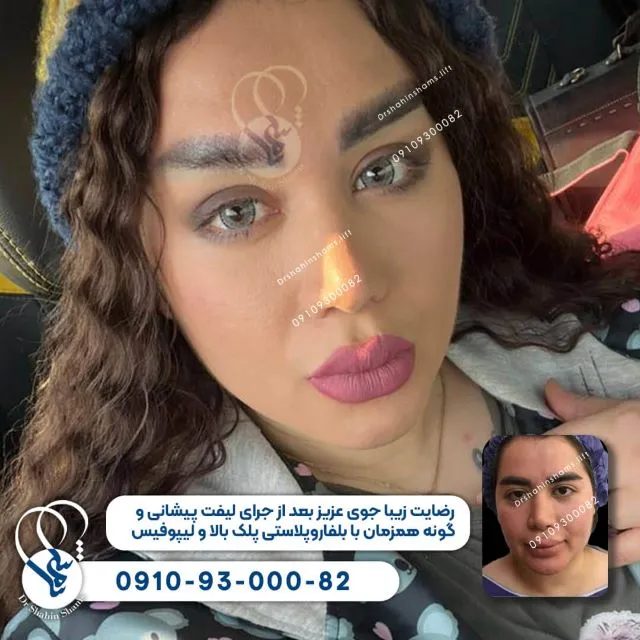 عمل لیفت صورت و پلک و بوکال و غبغب نمونه 01LC024 نمونه قبل و بعد عمل لیفت صورت و پلک و بوکال و غبغب