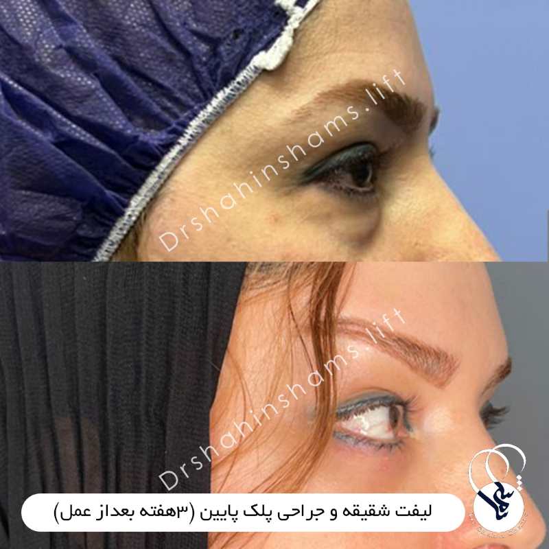نمونه قبل و بعد لیفت همزمان شقیقه و پلک پایین کد 01lc005 لیفت همزمان شقیقه و پلک پایین