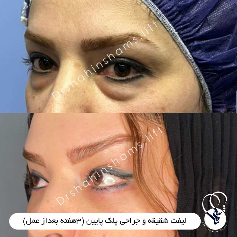نمونه قبل و بعد لیفت همزمان شقیقه و پلک پایین کد 01lc005 عکس لیفت همزمان شقیقه و پلک پایین