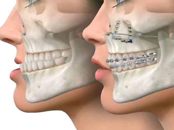 جراحی جینوپلاستی چانه چیست و چه افرادی به آن نیاز دارند جراحی چانه جراحی زیبایی چانه