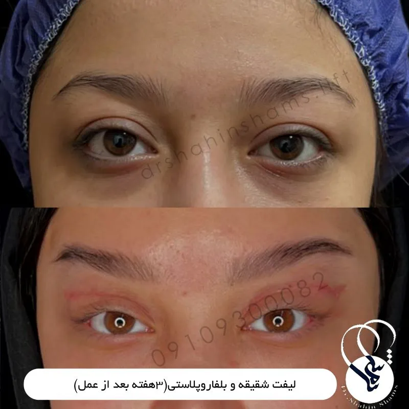 عمل لیفت شقیقه با جراحی بهمراه عکس لیفت شقیقه لیفت شقیقه با جراحی نمونه قبل و بعد جراحی همزمان شقیقه و بلفاروپلاستی پلک بالا