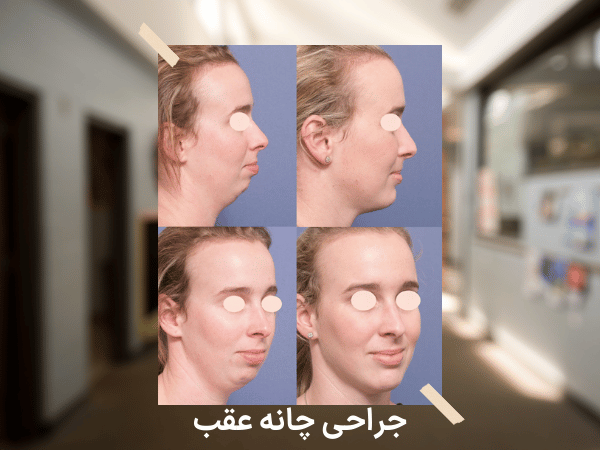 جراحی پروتز چانه چیست و روش و فواید و خطرات احتمالی جراحی پروتز چانه جراحی چانه عقب