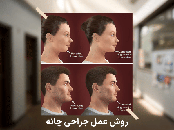 جراحی پروتز چانه چیست و روش و فواید و خطرات احتمالی جراحی پروتز چانه روش عمل جراحی چانه