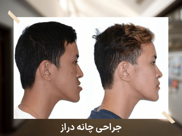 جراحی پروتز چانه چیست و روش و فواید و خطرات احتمالی جراحی پروتز چانه عمل جراحی چانه دراز
