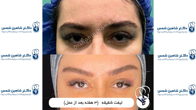 عمل لیفت شقیقه با جراحی بهمراه عکس لیفت شقیقه لیفت شقیقه با جراحی نمونه قبل و بعد جراحی لیفت شقیقه دائمی