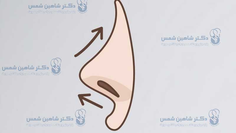 بالا بودن نوک بینی بعد از عمل رینوپلاستی بالا بودن نوک بینی بعد از عمل پیشگیری از بالا بودن نوک بینی بعد از عمل