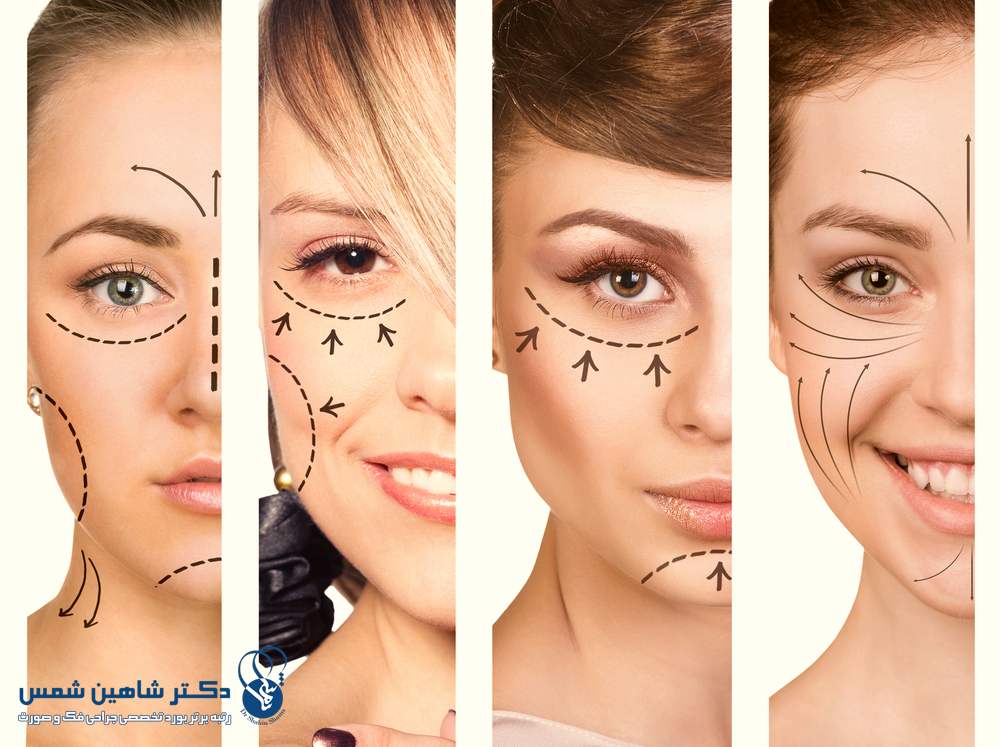 روشهای جدید لیفت صورت روشهای جدید لیفت صورت لیفت صورت با آر اف فرکشنال (RF Microneedling)