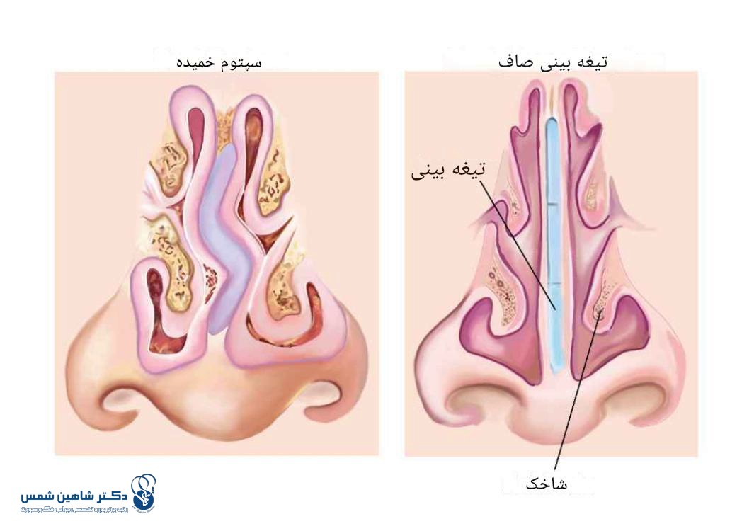 جراحی سپتوپلاستی چیست و چطور انجام میشود؟ جراحی سپتوپلاستی مزایا و نتایج مورد انتظار از جراحی سپتوپلاستی