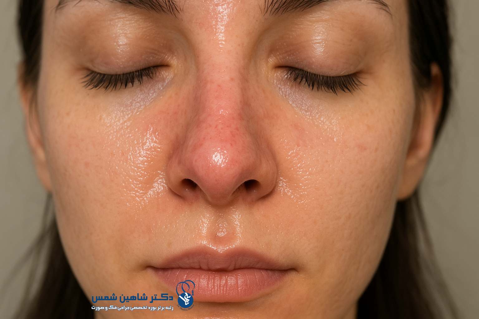 علت چرب شدن صورت بعد از عمل بینی و درمان آن علت چرب شدن صورت بعد از عمل بینی و درمان آن پیشگیری از تشدید چربی پوست بعد از عمل بینی