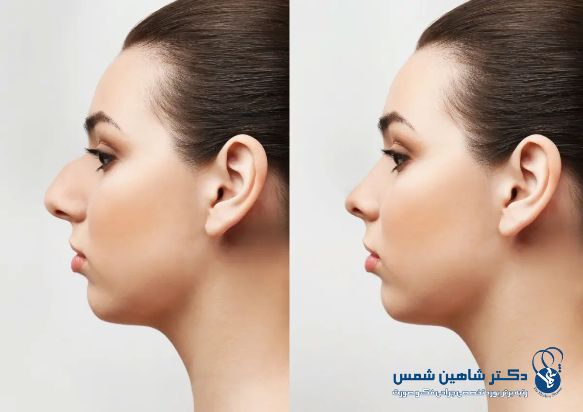 مقایسه کامل عمل بینی باز و بسته: کدام تکنیک بهتر است؟ مقایسه کامل عمل بینی باز و بسته میزان تغییرات مورد انتظار بیمار