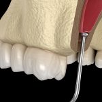 عمل لیفت سینوس چیست و چه ارتباطی با کاشت ایمپلنت دندان دارد؟