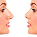 What is needed for a natural-looking nose job?
