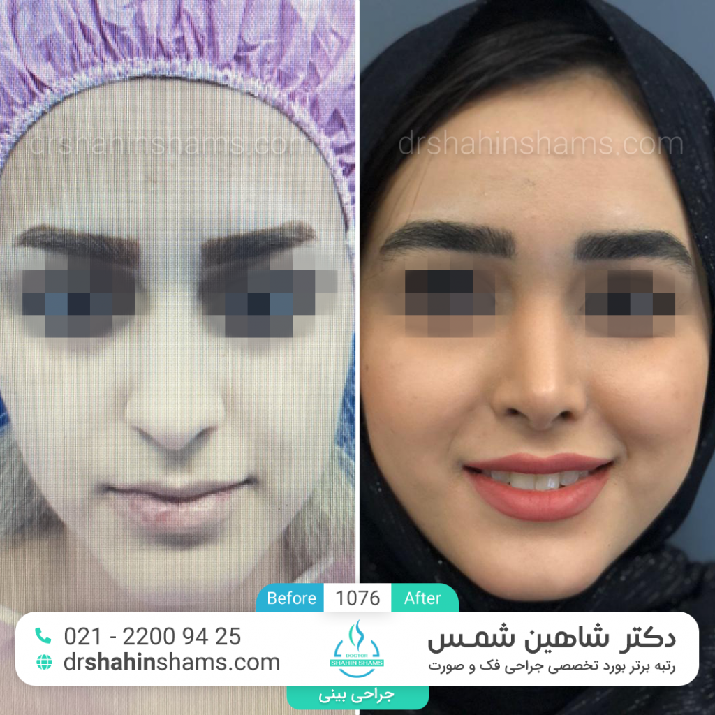 before after rhinoplasty
