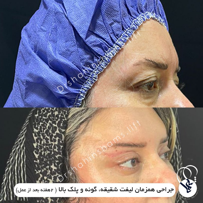 نمونه قبل و بعد عمل همزمان لیفت شقیقه و گونه و پلک