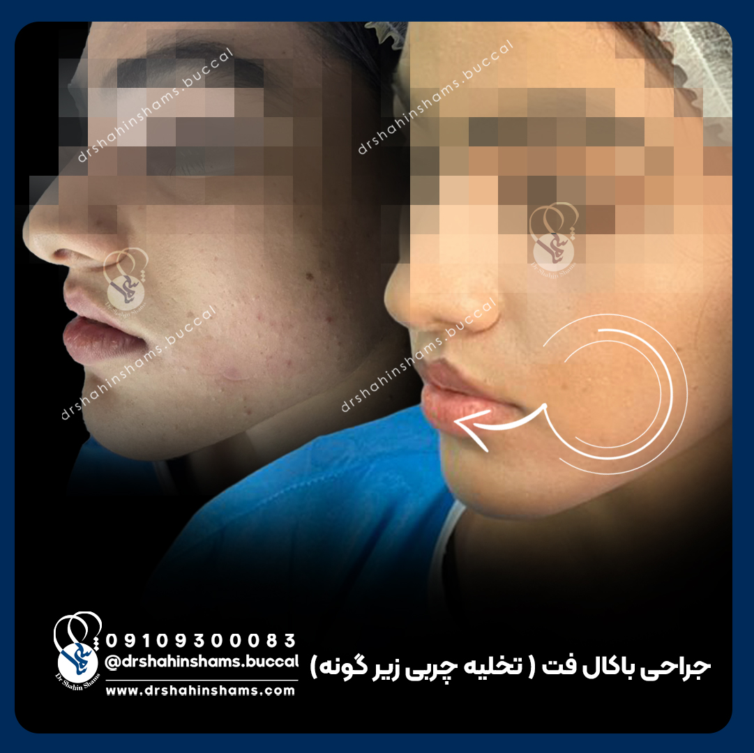 نمونه قبل و بعد بوکال فت با رضایت زیبا جو