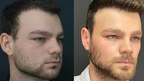 عکس قبل و بعد جراحی فک یا چانه