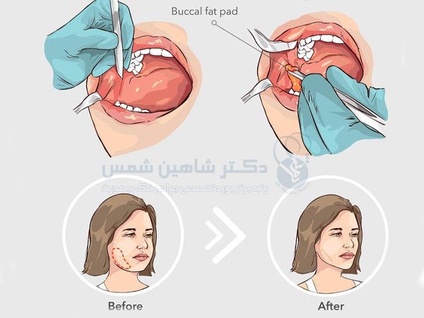 بوکال فت