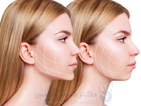 جراحی باکال فت