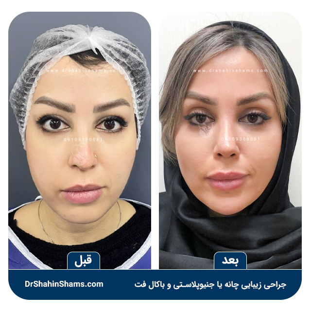 نمونه قبل و بعد عمل همزمان چانه و باکال فت