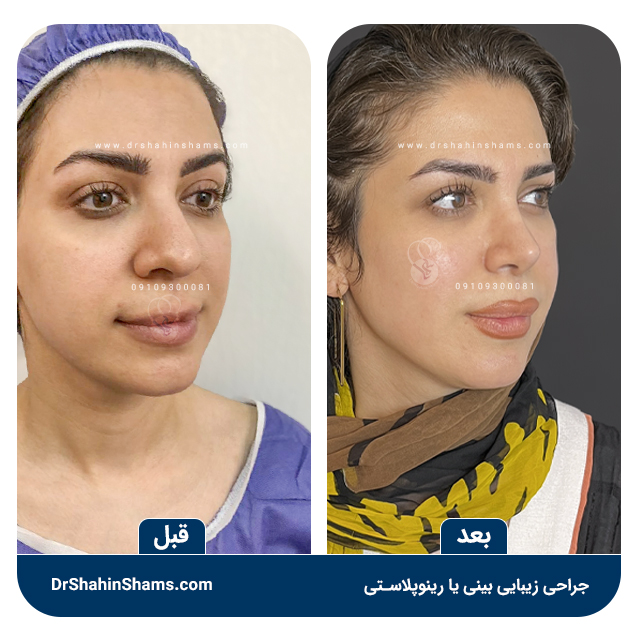 نمونه قبل و بعد رینوپلاستی یا عمل بینی کد 01R035