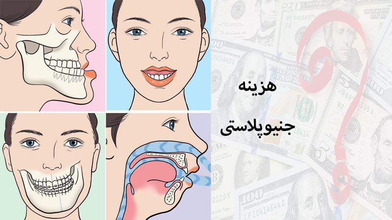 هزینه عمل جنیوپلاستی 1403