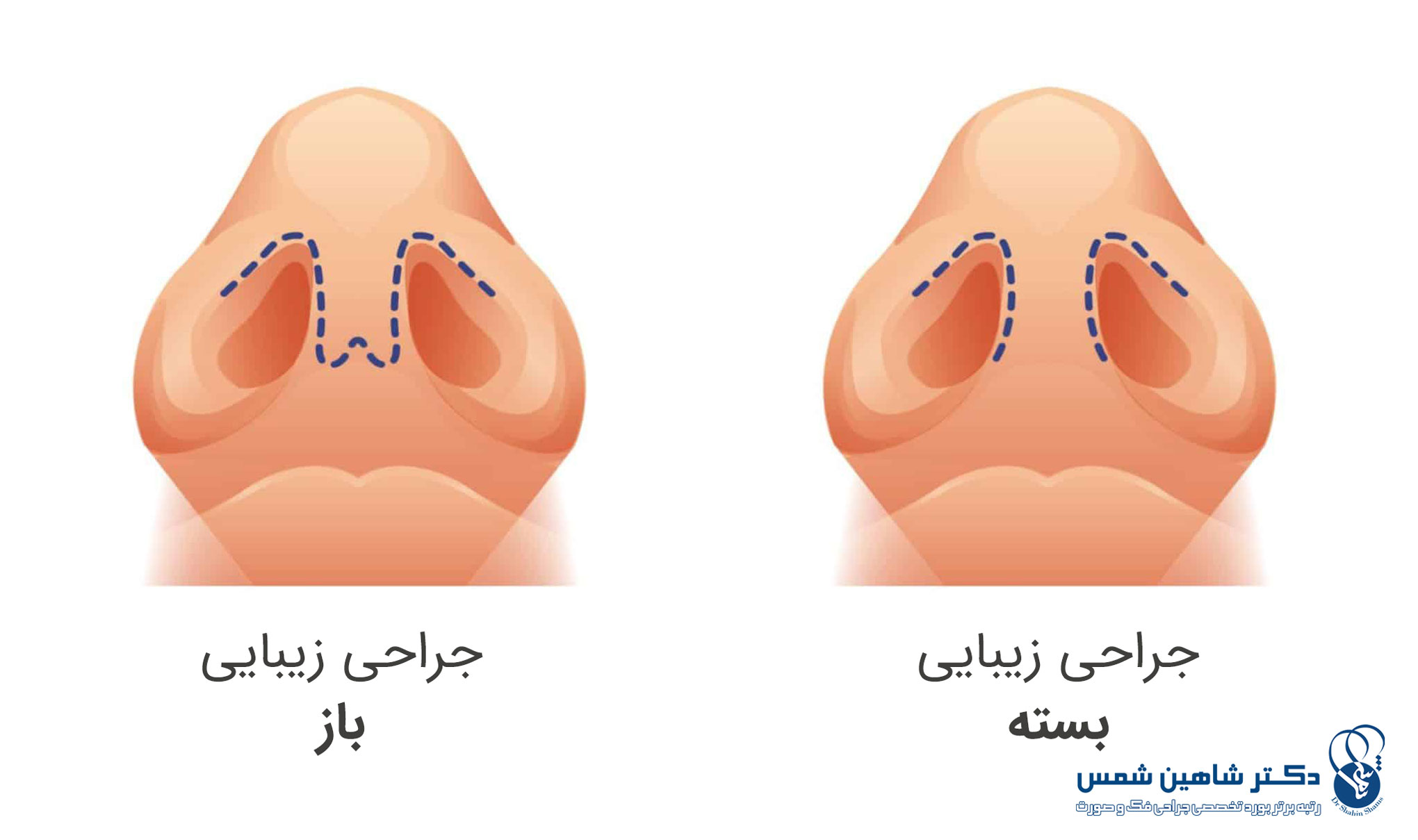 مقایسه کامل عمل بینی باز و بسته کدام تکنیک بهتر است؟