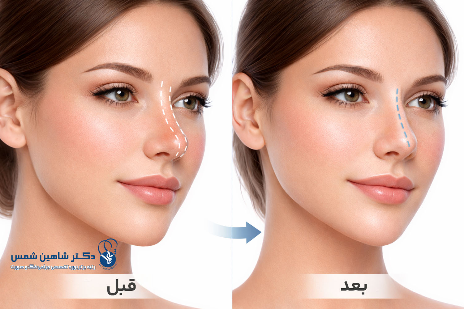 فرق ورم، فیبروز و برگشت بینی چیست؟